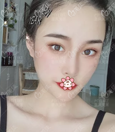 重慶美萊鄭楠納米美眼3.0案例：新月形和開扇形雙眼皮都蠻漂亮