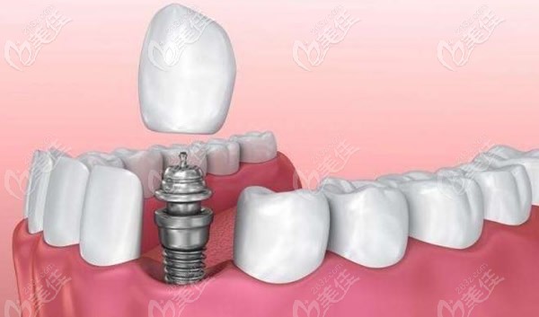 種植牙包括幾個部位 種植牙包括幾個部位