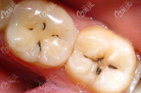 輕度的蛀牙