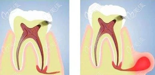 中、重度的蛀牙傷及牙髓