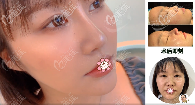 <!--<i data=20240703-sp></i>-->駱顯紅鼻綜合案例 <!--<i data=20240703-sp></i>-->駱顯紅鼻綜合案例