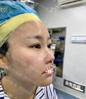 鼻梁高了好多 鼻梁高了好多