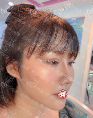 <!--<i data=20240703-sp></i>-->駱顯紅肋骨鼻術(shù)后1個(gè)月 <!--<i data=20240703-sp></i>-->駱顯紅肋骨鼻術(shù)后1個(gè)月