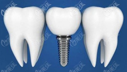 種植牙價(jià)格