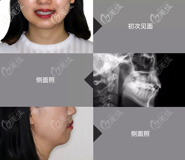 去北京牙管家做牽引術(shù)前的準(zhǔn)備工作 去北京牙管家做牽引術(shù)前的準(zhǔn)備工作