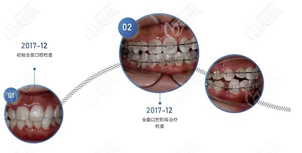 我做中線偏移用的陶瓷托槽矯正 我做中線偏移用的陶瓷托槽矯正