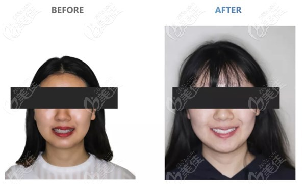 中線偏斜正畸怎么牽引？看我20個月后唇側(cè)陶瓷固定矯正的效果案例