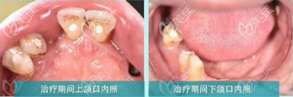 蘭州牙王國(guó)數(shù)字化口腔全口磁性附著體義齒修復(fù)前 蘭州牙王國(guó)數(shù)字化口腔全口磁性附著體義齒修復(fù)前