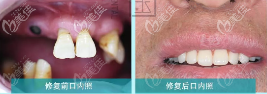 蘭州牙王國(guó)數(shù)字化口腔,全口磁性附著體義齒修復(fù)案例:多顆牙缺失不一定非要種植牙!