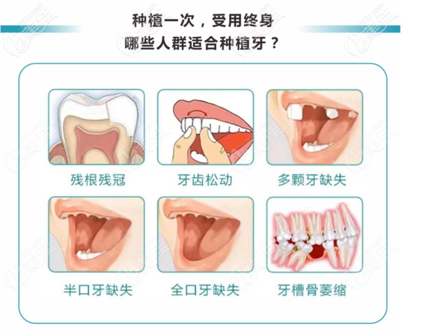 哪些人適合做種植牙