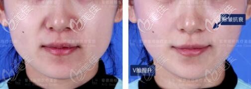 20歲+做熱瑪吉真人前后對(duì)比照 20歲+做熱瑪吉真人前后對(duì)比照