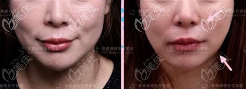 通過3組真人案例圖來告訴你大連誰家熱瑪吉做得好？