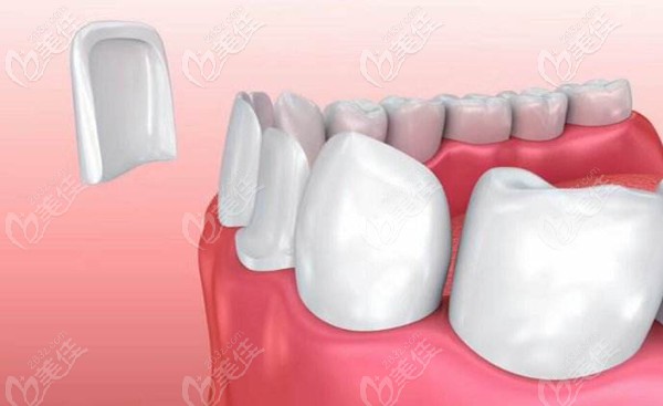 冰瓷貼面和全瓷貼面哪個(gè)好 冰瓷貼面和全瓷貼面哪個(gè)好