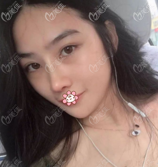 其實在去貴陽美萊做半肋軟骨鼻綜合前，我還面診過貴陽華美