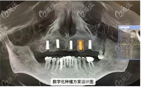羅醫(yī)生給秦先生設(shè)計(jì)的數(shù)字化種植方案設(shè)計(jì)圖 羅醫(yī)生給秦先生設(shè)計(jì)的數(shù)字化種植方案設(shè)計(jì)圖