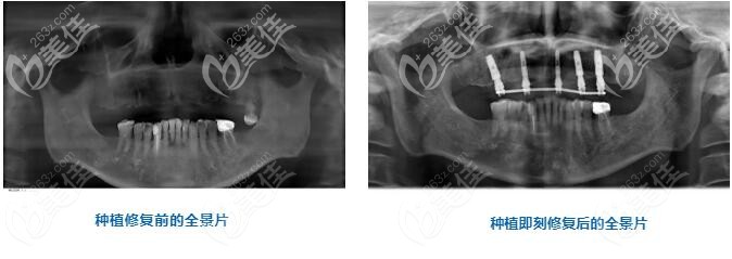 半口牙種植術(shù)后即刻全景片的對(duì)比 半口牙種植術(shù)后即刻全景片的對(duì)比