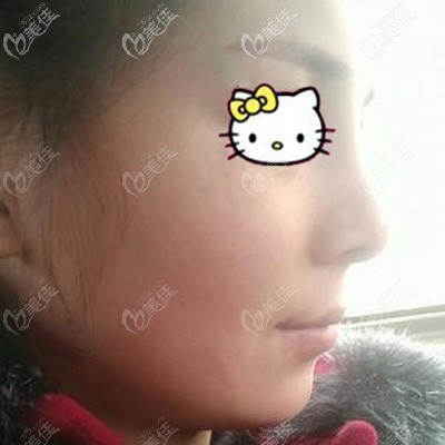 立秀加強型膨體隆鼻術后8天拆線 立秀加強型膨體隆鼻術后8天拆線