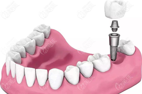 殷龍醫(yī)生淺談做種植牙，醫(yī)生技術和種植材料哪個更重要