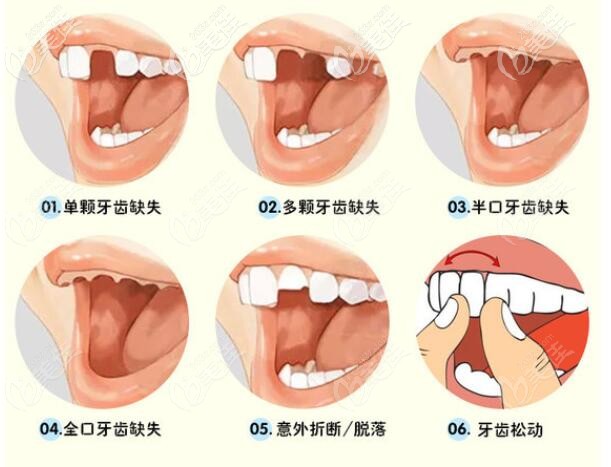 牙齒缺失所帶來的困擾可以通過種植牙改善