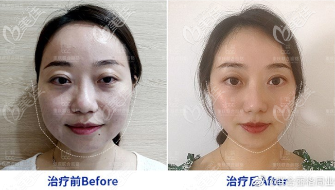 黃金微雕面部吸脂術(shù)前術(shù)后對比照