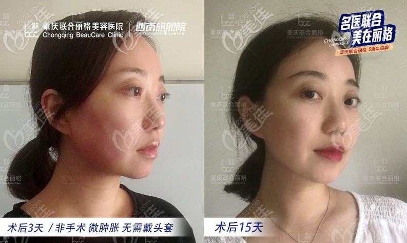 術(shù)后半個月左右