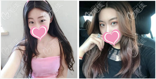 太原華美全切雙眼皮案例