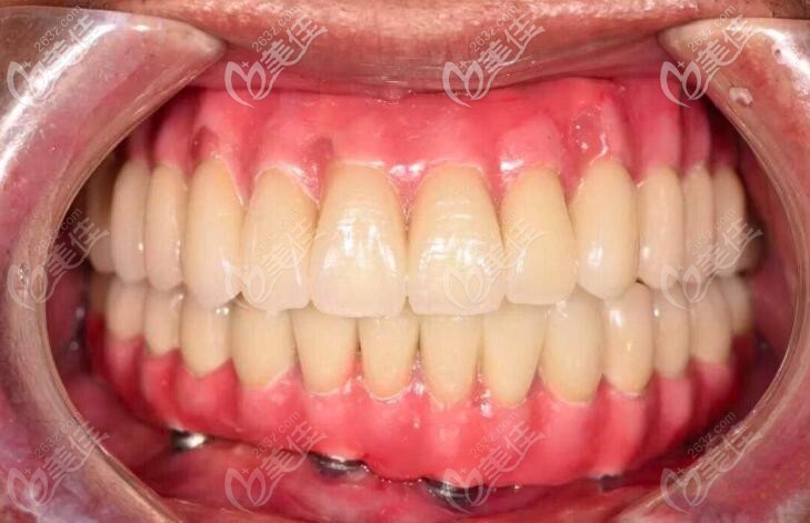 all-on-6全口種植圖片 all-on-6全口種植圖片