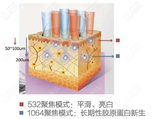 超皮秒祛黑頭的原理