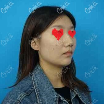 做歐洲之星fotona4d面部提升術(shù)前照 做歐洲之星fotona4d面部提升術(shù)前照