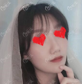 歐洲之星Fotona 4D一周恢復(fù)效果照 歐洲之星Fotona 4D一周恢復(fù)效果照