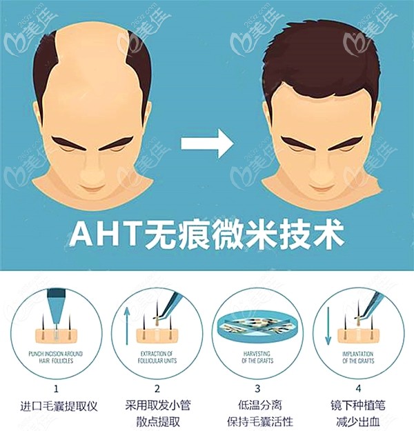 aht納米無痕植發(fā)技術(shù)