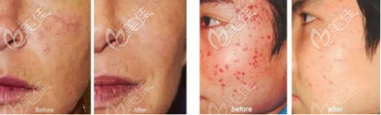 做了一個(gè)療程的術(shù)前術(shù)后對(duì)比圖 做了一個(gè)療程的術(shù)前術(shù)后對(duì)比圖