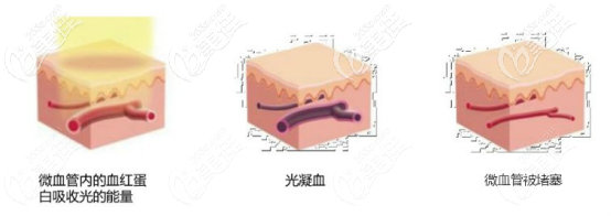 595染料激光Vbeam去除紅血絲的作用原理 595染料激光Vbeam去除紅血絲的作用原理