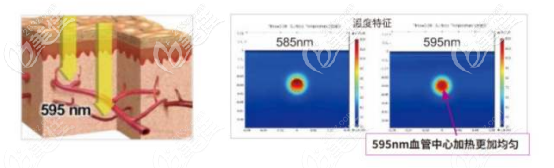 595nm波長(zhǎng)加熱血管的示意圖 595nm波長(zhǎng)加熱血管的示意圖