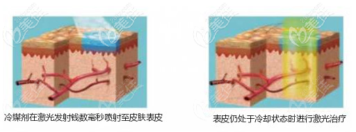 DCD動(dòng)態(tài)冷卻系統(tǒng) DCD動(dòng)態(tài)冷卻系統(tǒng)