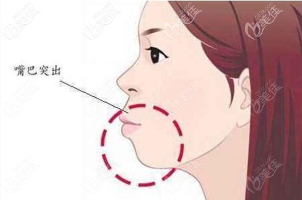 齙牙引起的凸嘴 齙牙引起的凸嘴