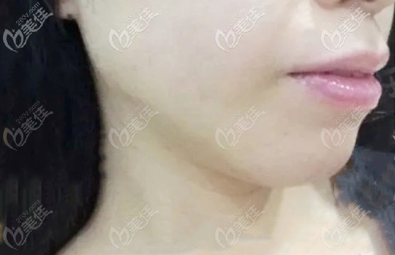 整牙前的側(cè)面照 整牙前的側(cè)面照