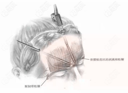 內窺鏡額頭除皺的優(yōu)勢 內窺鏡額頭除皺的優(yōu)勢