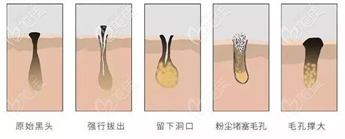 超皮秒去黑頭毛孔