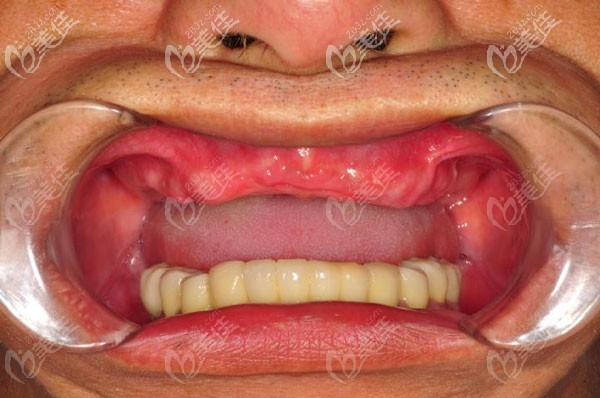 找南寧柏樂口腔吳安世醫(yī)生做allon4半口種植牙前 找南寧柏樂口腔吳安世醫(yī)生做allon4半口種植牙前