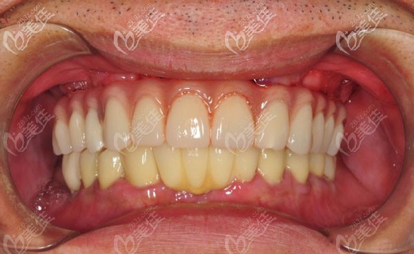 南寧柏樂口腔吳安世醫(yī)生做allon4半口即刻種植牙真實(shí)案例,你來看！