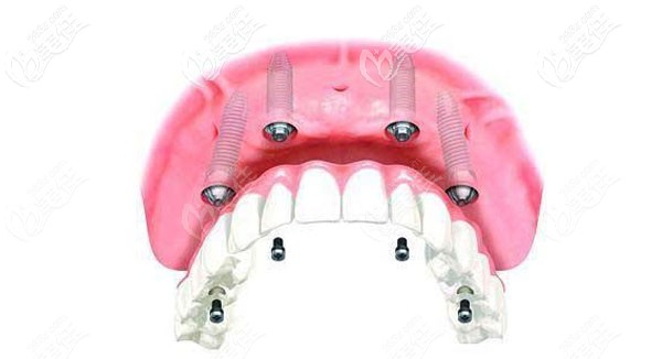 all-on-4種植牙的優(yōu)勢大于弊端 all-on-4種植牙的優(yōu)勢大于弊端