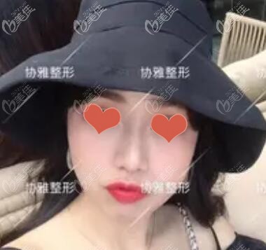 找鄒笑寒做進口硅膠假體+耳軟骨鼻綜合有2個多月了，來看下效果怎么樣