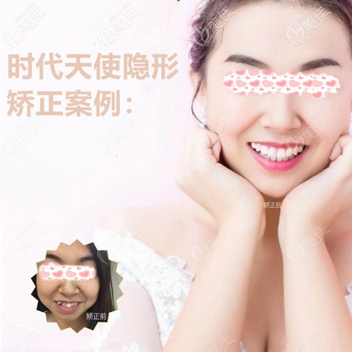 千辛萬苦找到的太原眾牙時代天使隱形矯正案例，你不看看嗎