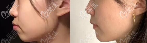 骨性齙牙矯正日記:在岳陽陽光口腔戴半隱形陶瓷牙套的日子...