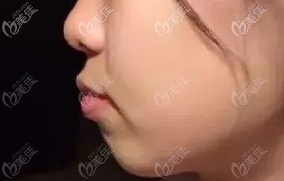 骨性齙牙矯正前的照片