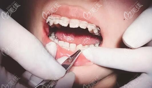 骨性齙牙戴半隱形陶瓷托槽的照片