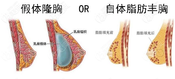 硅膠假體隆胸好還是自體脂肪豐胸好 硅膠假體隆胸好還是自體脂肪豐胸好