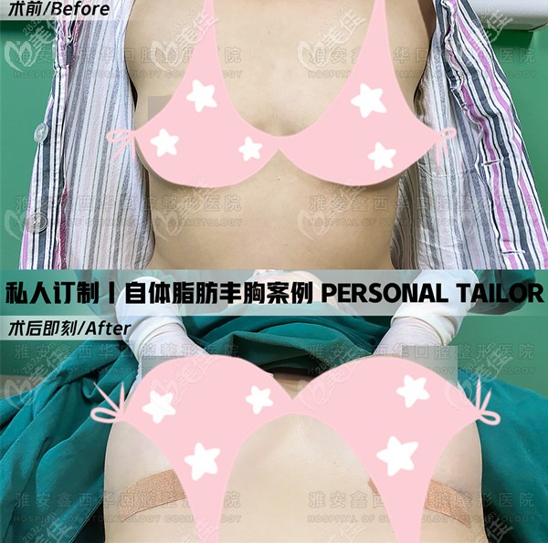 雅安鑫西華整形醫(yī)院自體脂肪隆胸真實帖子:術(shù)后即刻效果讓我告別一馬平川