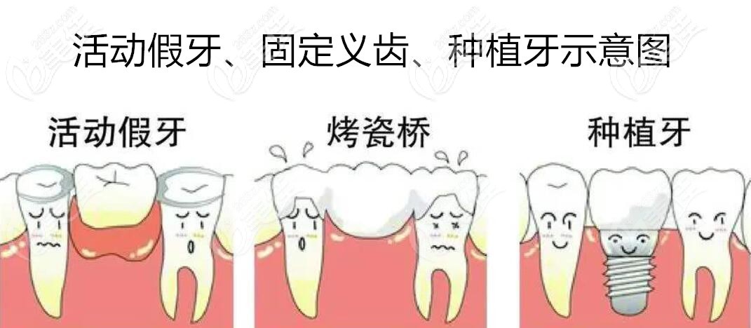 常見的牙齒缺失修復(fù)方法有哪些呢？  據(jù)黃復(fù)景院長(zhǎng)介紹，常用修復(fù)缺牙